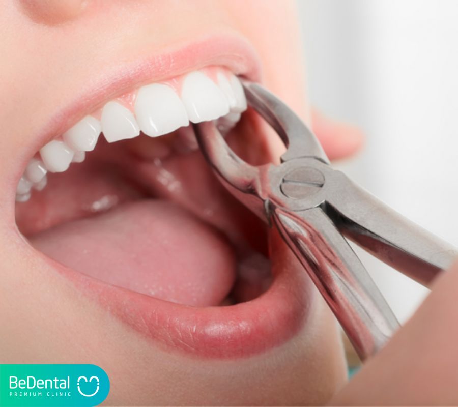 Lợi ích của việc nhổ răng trước khi niềng răng