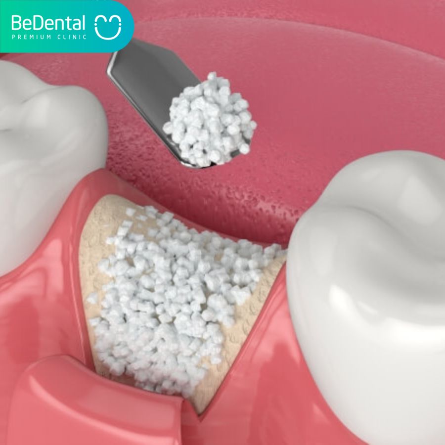 Ghép xương răng là một thủ thuật nha khoa nhỏ nhằm bổ sung thêm xương vào bên trong hàm răng