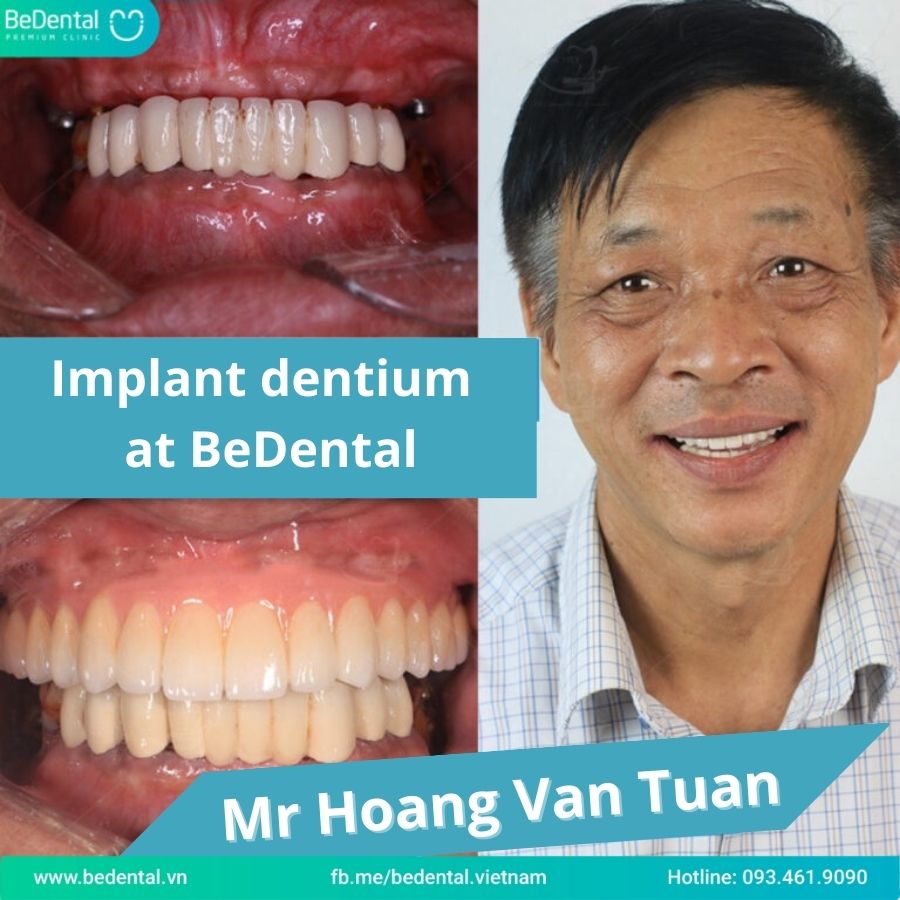 Clients use American implant Dentium at BeDental