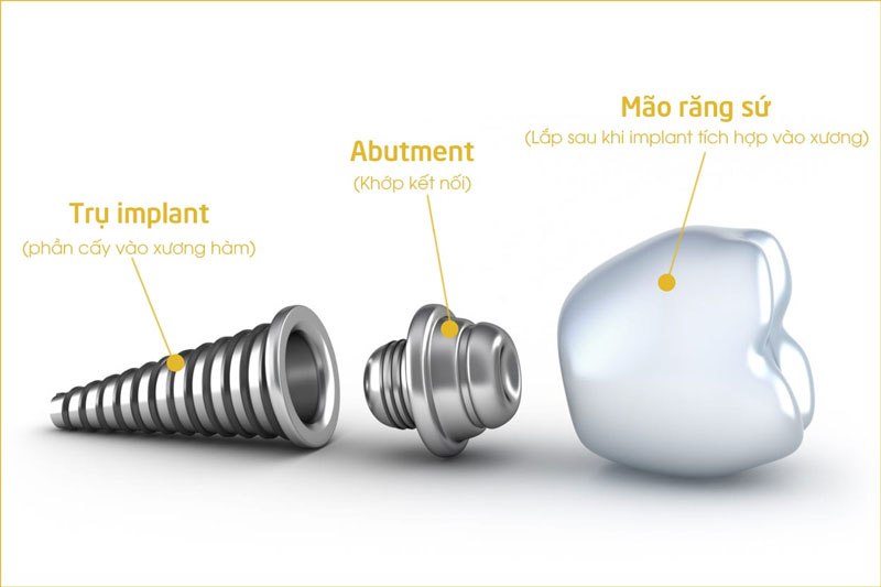 Structure of American Implant Dentium