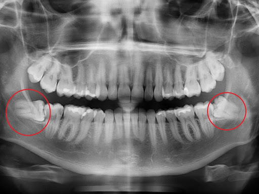Khi mọc răng khôn bị đau nhức, cần nhanh chóng đến nha khoa để thăm khám và chụp X-Quang