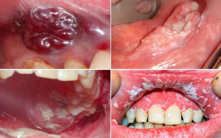 Một số triệu chứng của bệnh lở miệng.