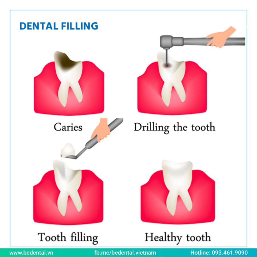 Tooth Fillings Procedure
