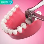 Tooth extraction