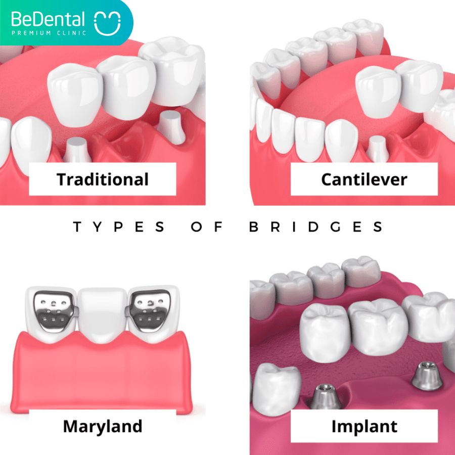 Dental bridge types