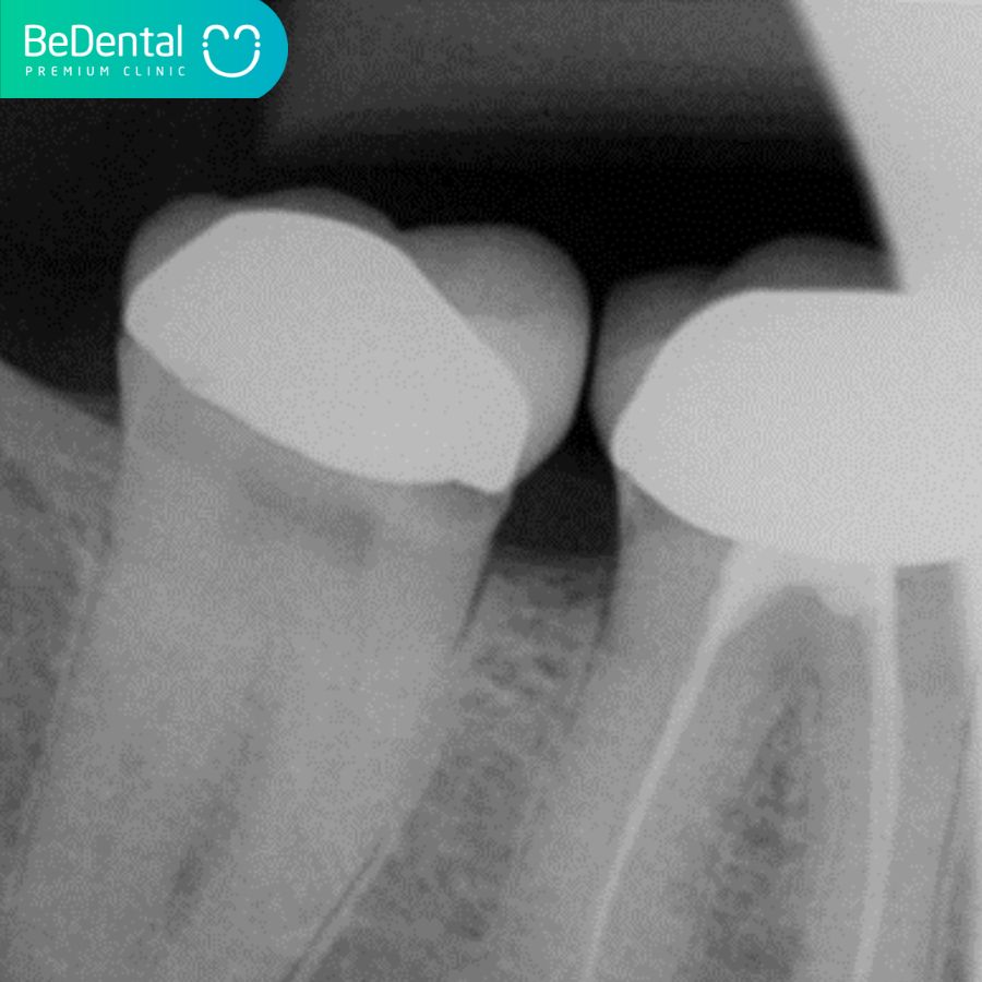 Periapical: dental x-ray