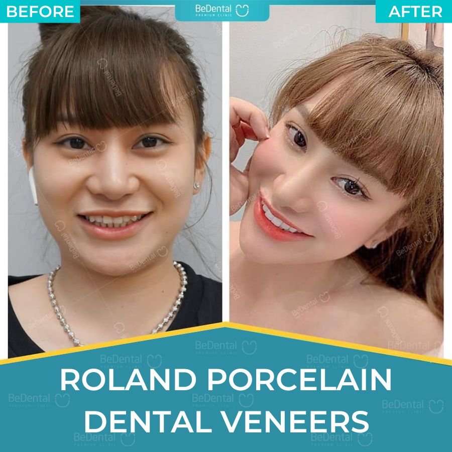 pocelain veneers