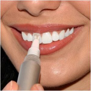 Bút tẩy trắng không khắc phục được tình trạng răng ố vàng nặng