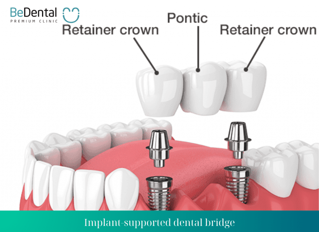 Implant supported dental bridge