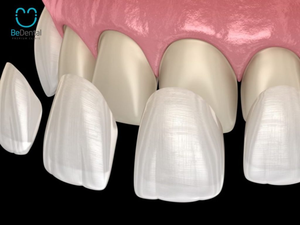 Zirconia veneer and 6 common concerns 4 zirconia veneers