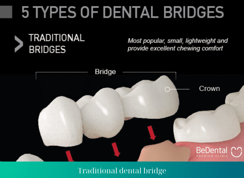 Traditional dental bridge