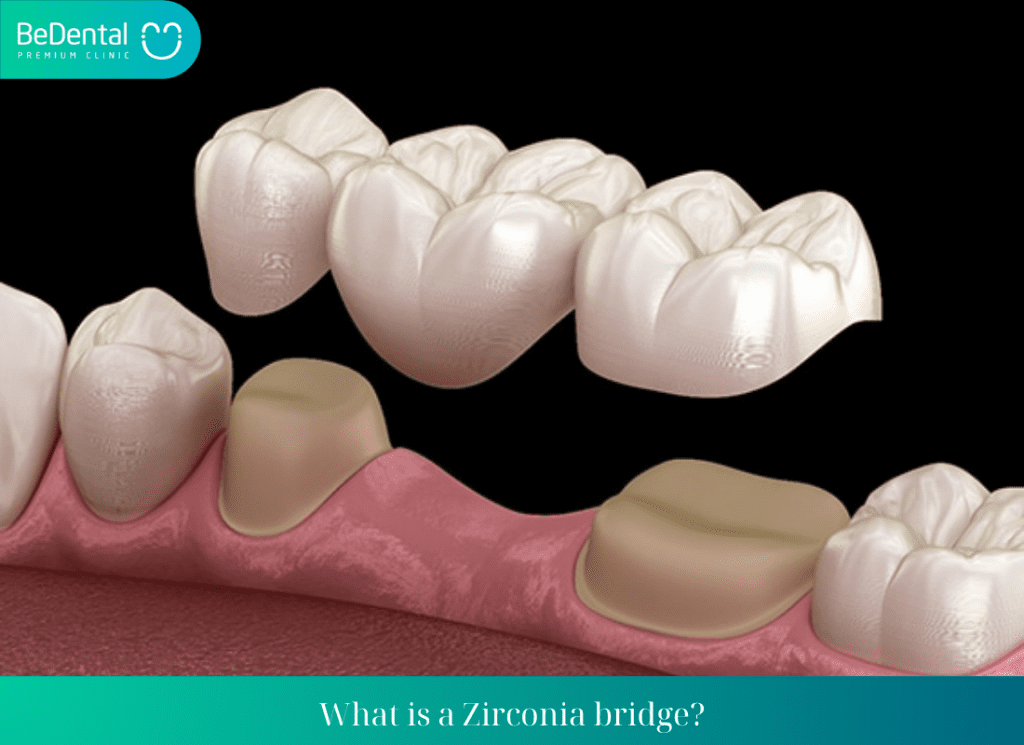 What is a Zirconia bridge