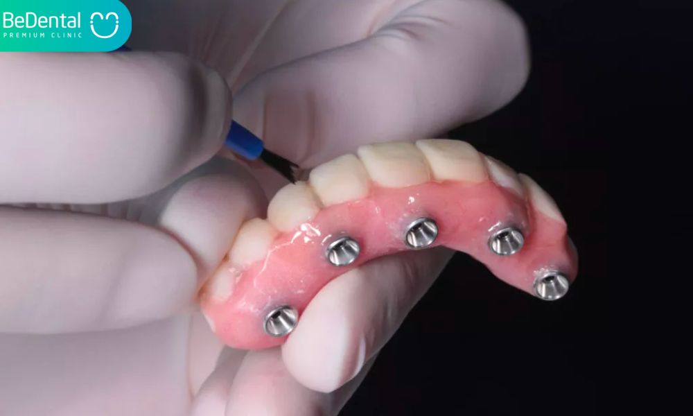Complete-arch implant-supported monolithic zirconia