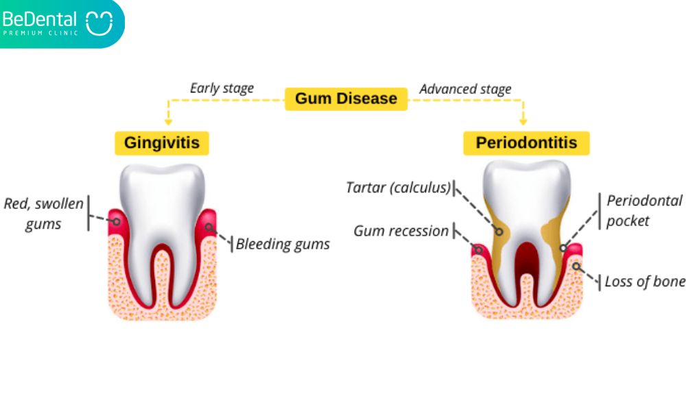 The difference between periodontitis and gingivitis