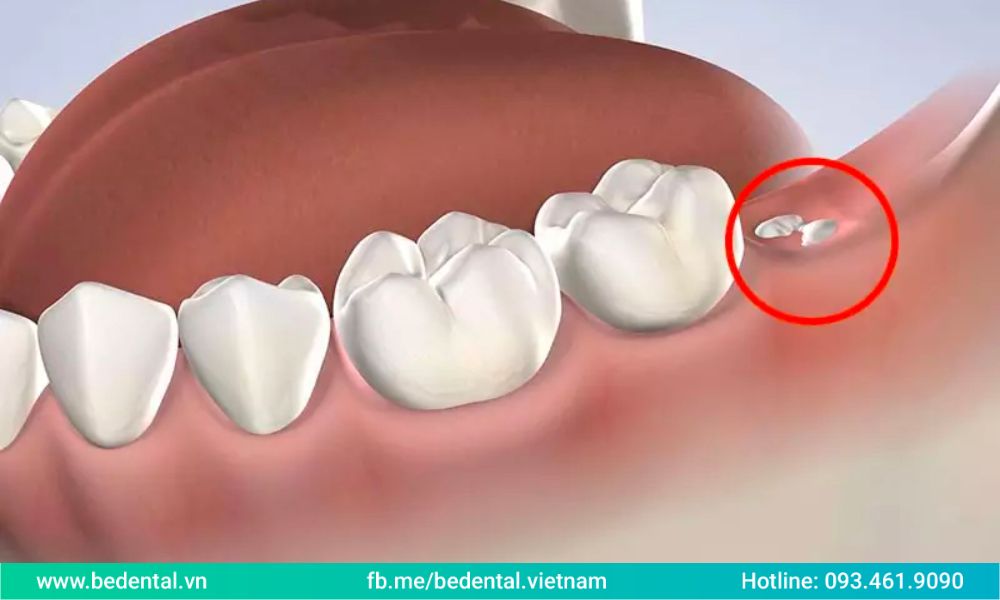 a wisdom tooth has just partially emerged over the gums with the major portion still embedded in the jawbone