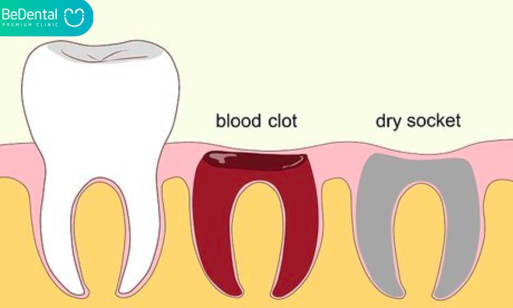 Keep an eye out for dry socket symptoms