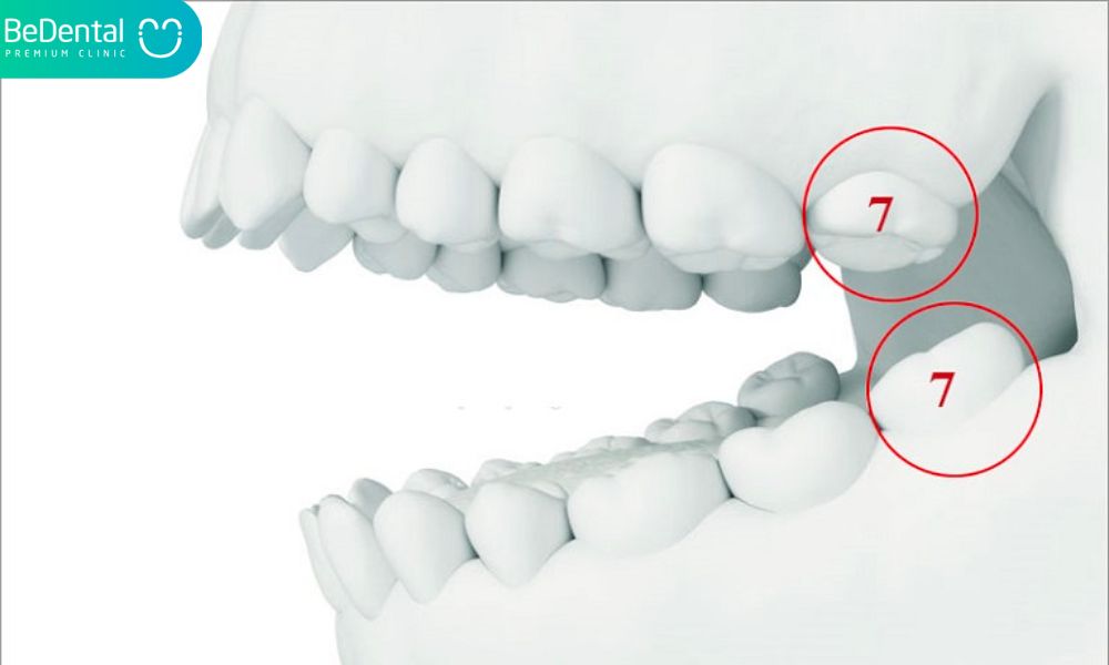 Tooth number 8 issues such discomfort, decay in nearby teeth, inflammation, and damage to tooth number 7
