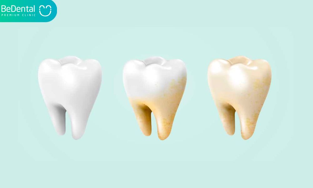 Tooth discoloration