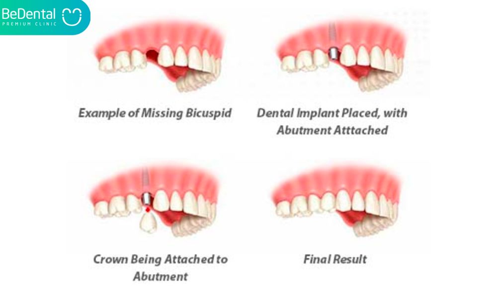 Dental Implant Procedure