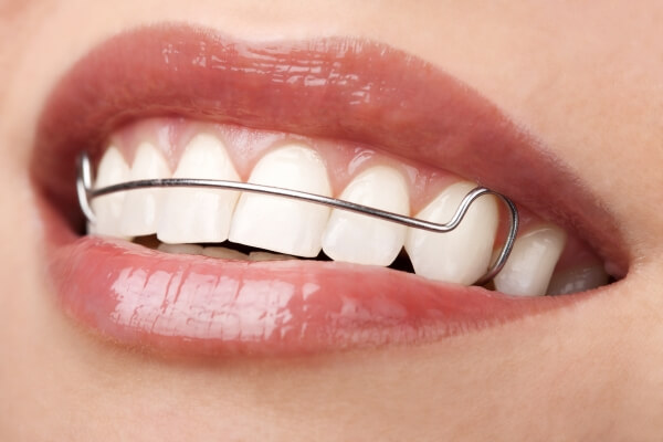  Hàm duy trì cố định kim loại giúp cố định vị trí răng và tiết kiệm chi phí 
