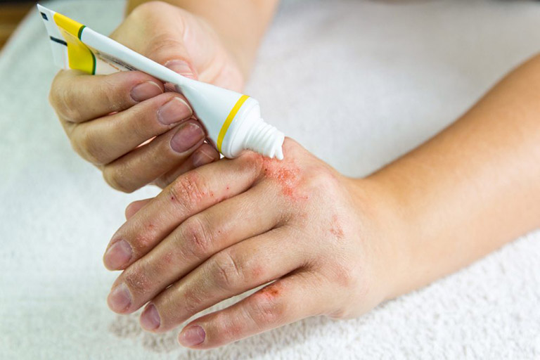 Kem dưỡng ẩm da, mềm da khi thời tiết lạnh và khô, tránh để da nứt nẻ sẽ làm dễ gây ngứa