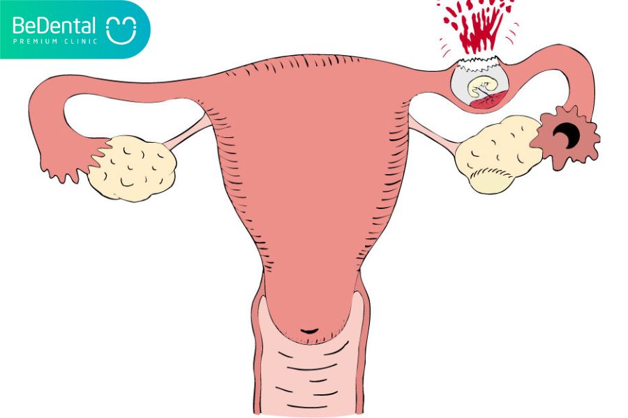 Đau bụng dưới do mang thai ngoài tử cung