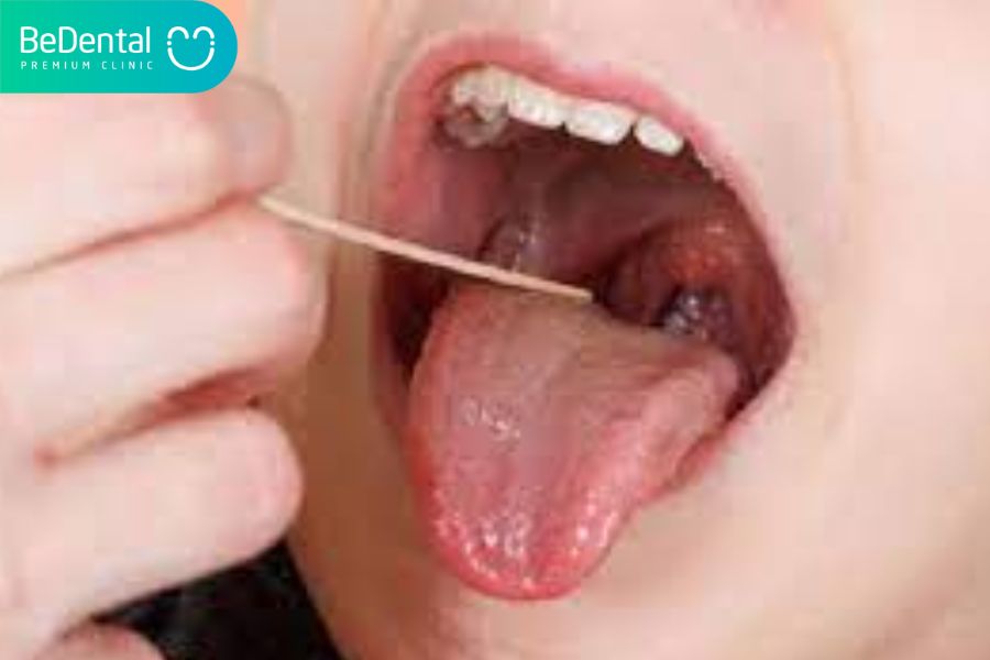 trong miệng xuất hiện mủ là dấu hiệu cho thấy viêm tuyến nước bọt