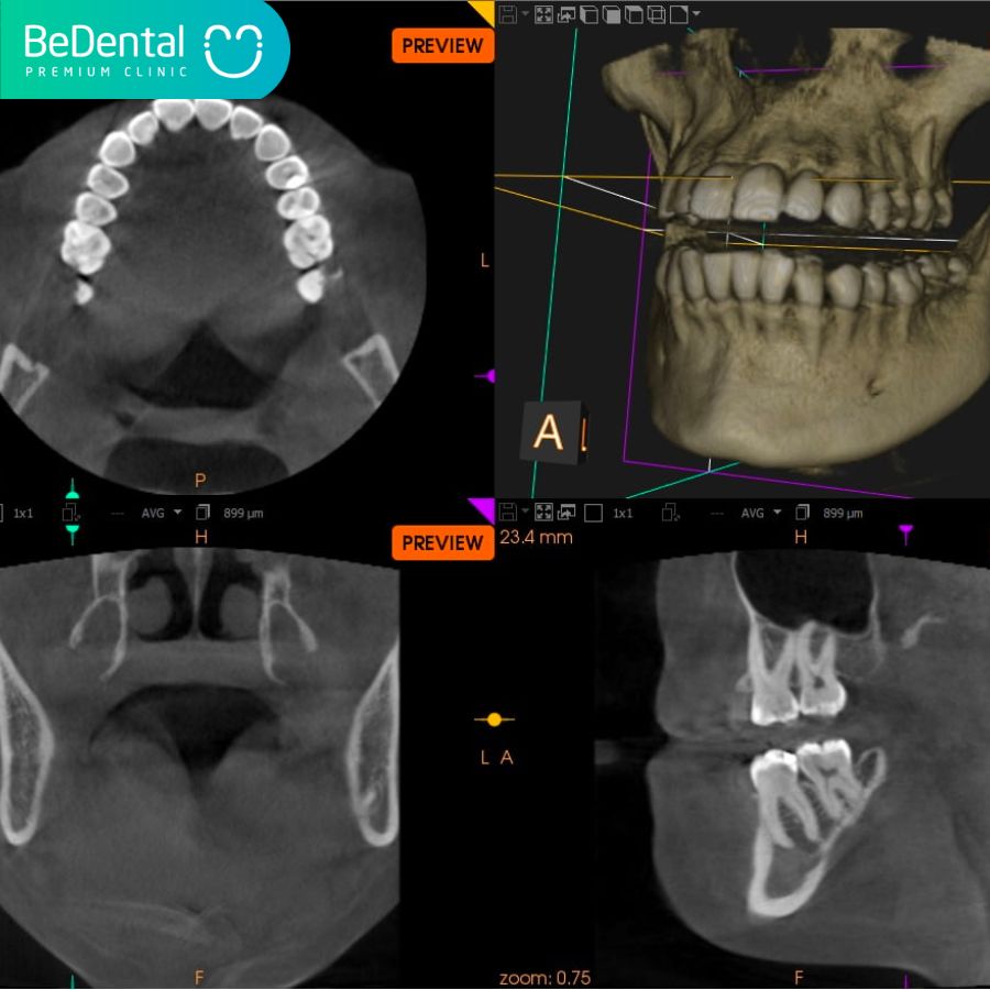CBCT radiograph for a 3D bone examination