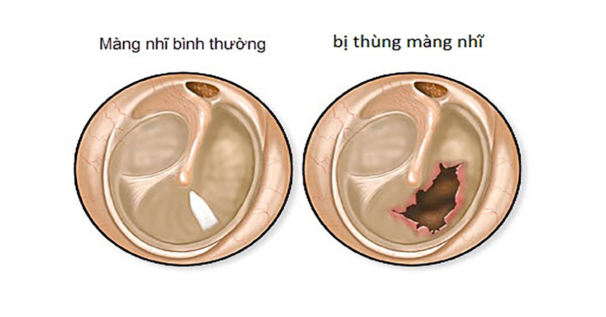 Thủng màng nhĩ là tình trạng lớp mô mỏng ngăn cách giữa ống tai ngoài và tai giữa bị rách hoặc thủng