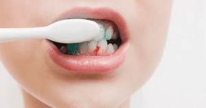 Hậu quả của chảy máu chân răng với sức khoẻ răng miệng
