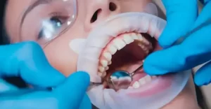 Trường hợp bọc răng sứ không cần thiết phải chữa tuỷ