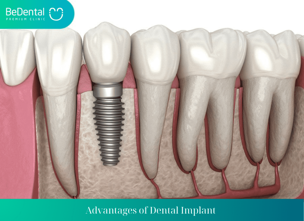 Advantages of Dental Implant