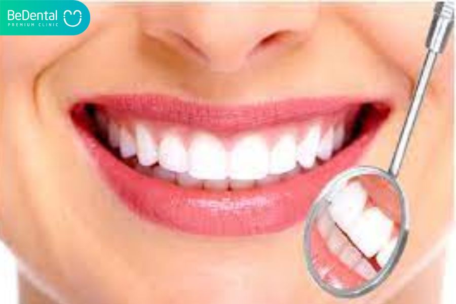 Trường hợp bọc răng sứ thẩm mỹ không cần thiết phải chữa tủy răng
