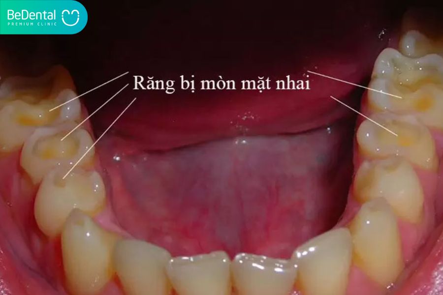 Dấu hiệu nhận biết răng bị mòn