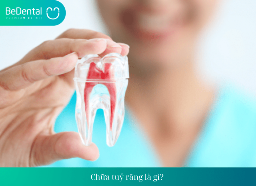 Chữa tuỷ răng là gì? 