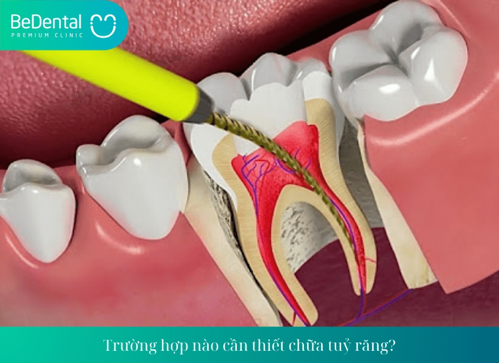 Trường hợp nào cần thiết chữa tuỷ răng?