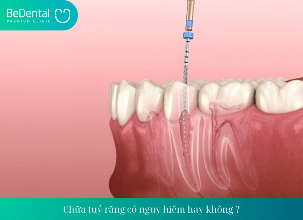 Chữa tuỷ răng có nguy hiểm hay không ?