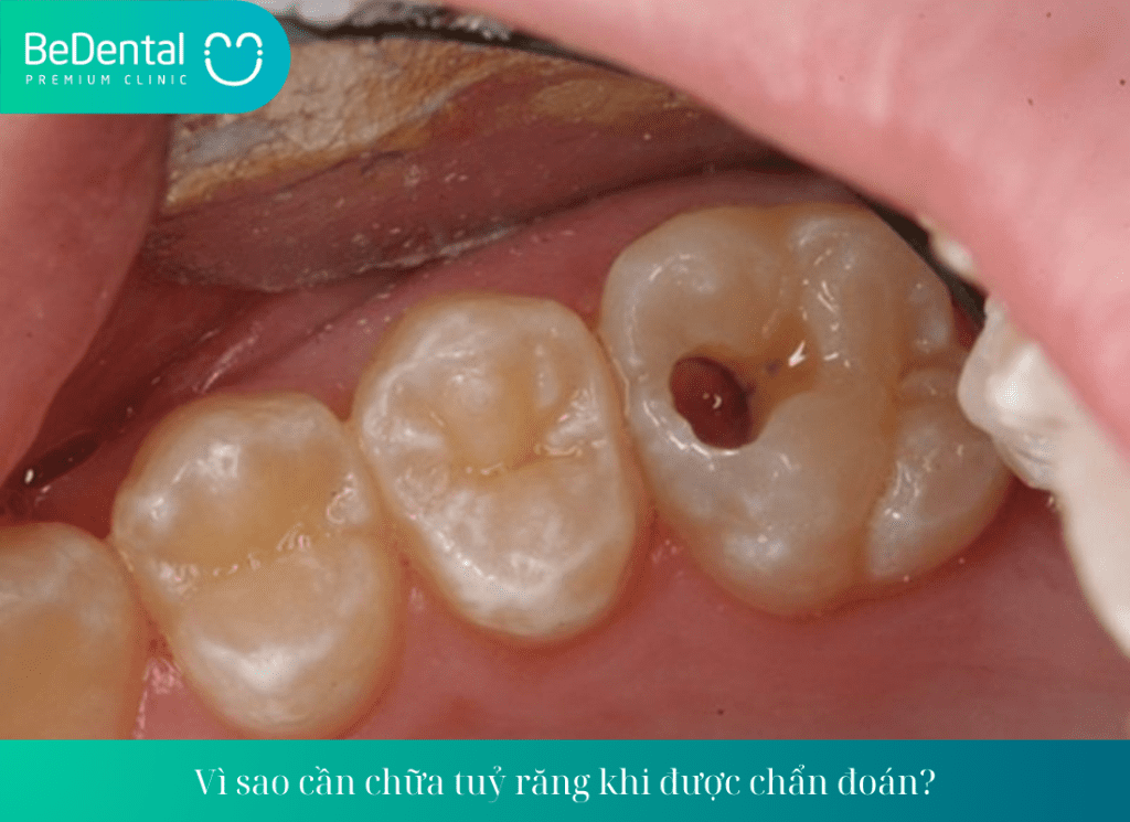 Vì sao cần chữa tuỷ răng khi được chẩn đoán?