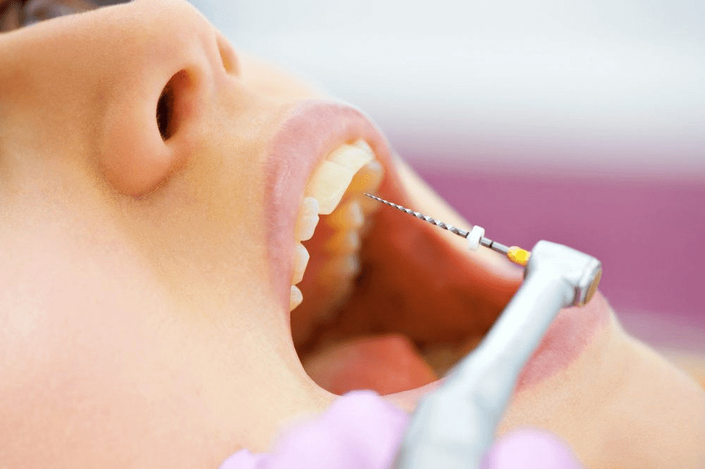 Can You Get Braces After Root Canal Treatment in Vietnam? 4 Modern Root Canal Therapy