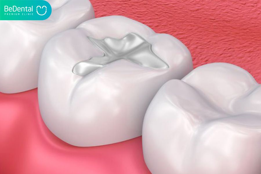 Răng sâu thì sau khi hàn răng xog có thể được phục hồi