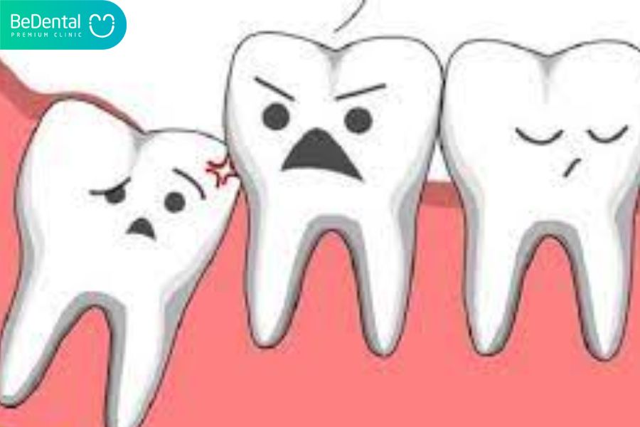 Tác hại của răng khôn mọc ngầm