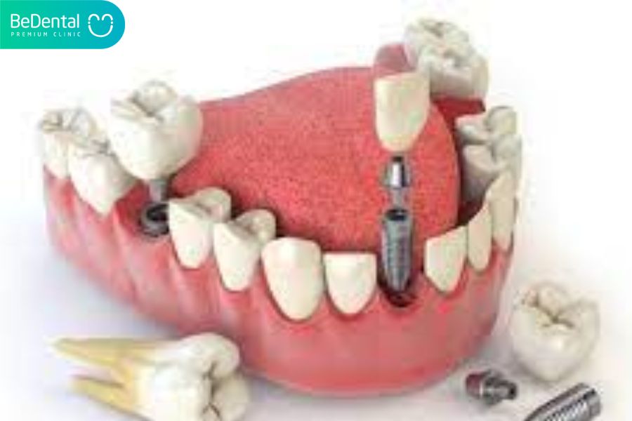 Nếu đã bị thủng sàn răng và chóp tuỷ thì bác sĩ sẽ tiến hành nhổ bỏ chiếc răng đó và sau 1 khoảng phải trồng implant