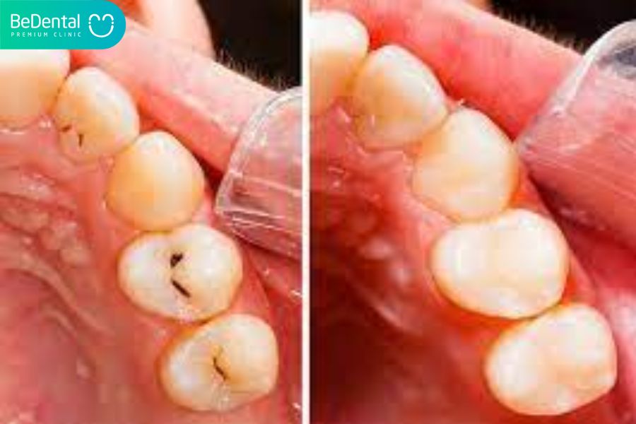 Phí Hàn răng được dựa trên tình trạng của răng