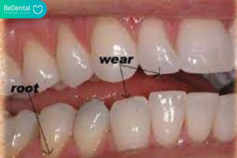 Triệu chứng của mòn răng
