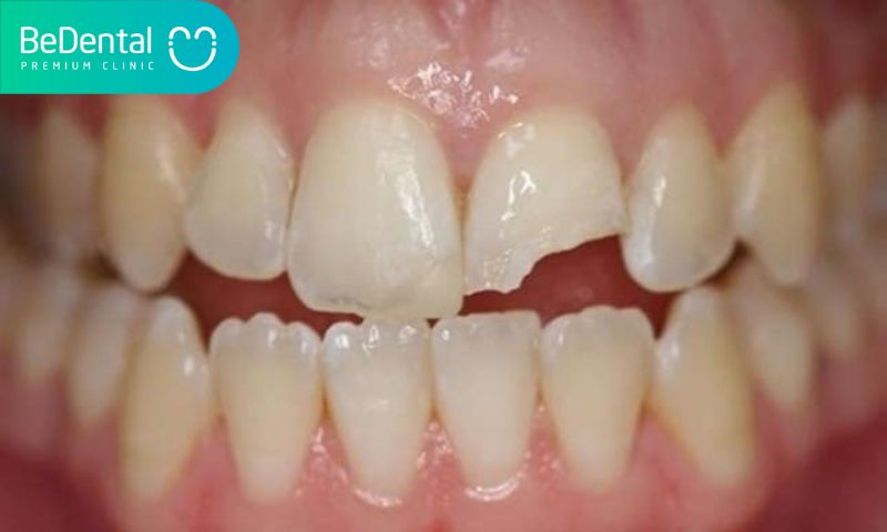 thế nào gọi là răng mẻ, lí do răng bị mẻ