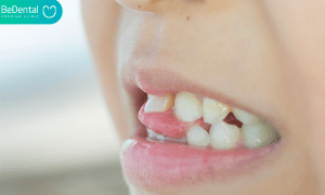 loose teeth