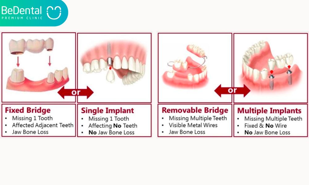 Dental Implants and Dental Bridges