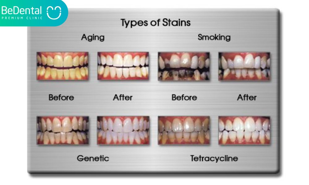 Types of tooth discoloration