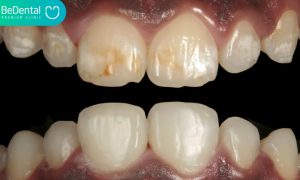 Teeth fluorosis