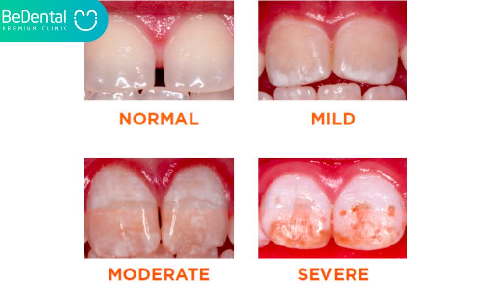 How is fluorosis diagnosed?